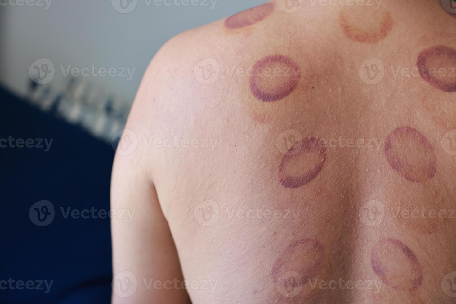 Physical therapy with cupping for back pain. Red circles are caused by cupping. red marks left on back skin. Treatment with traditional Chinese medicine. about of treatment, therapy, medical, care. photo