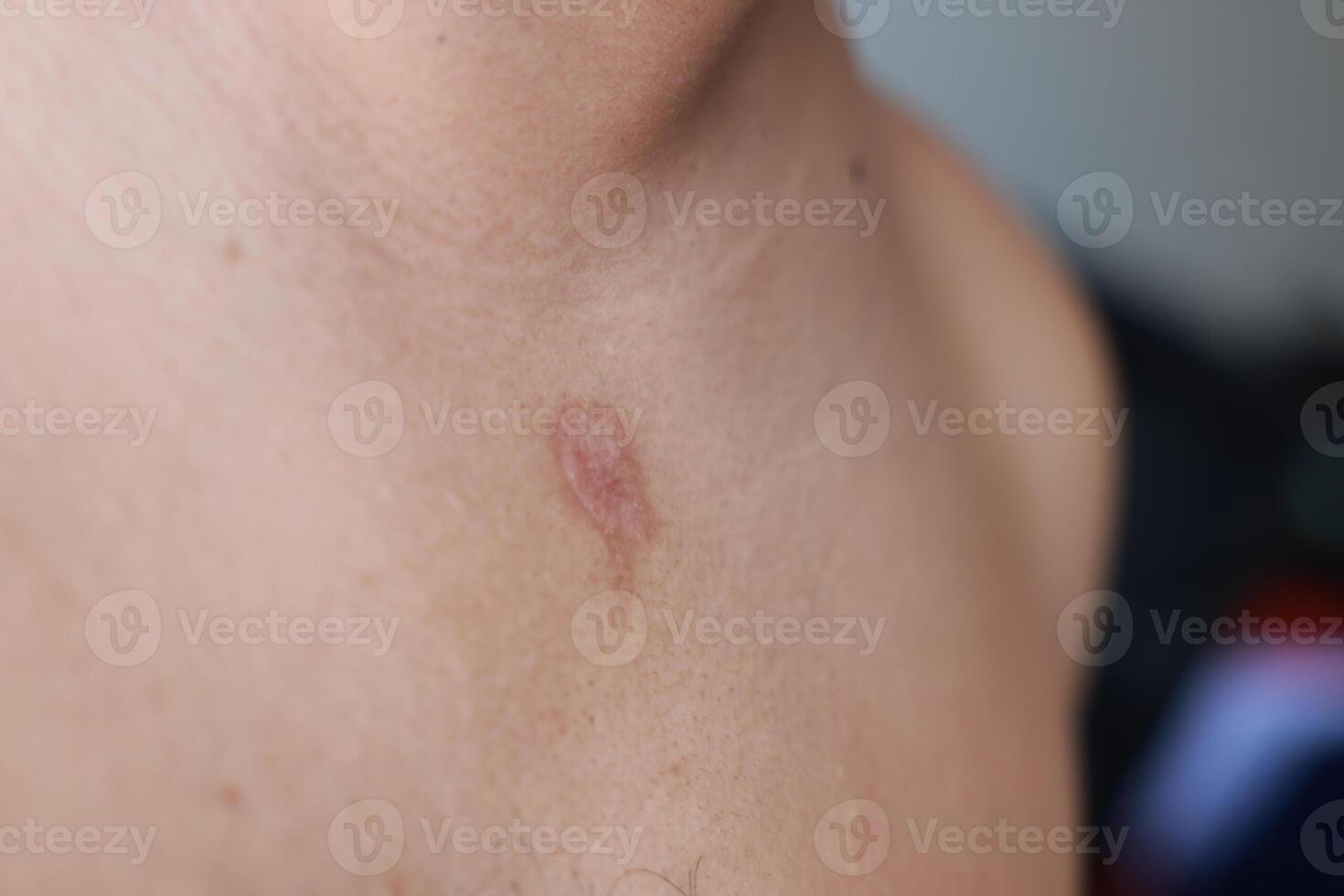 Asian man has blisters on his chest from oil splashes while cooking. Pityriasis rosea disease on the chest and neck on an isolated background. concept of healthcare, treat, medicine, injured. photo