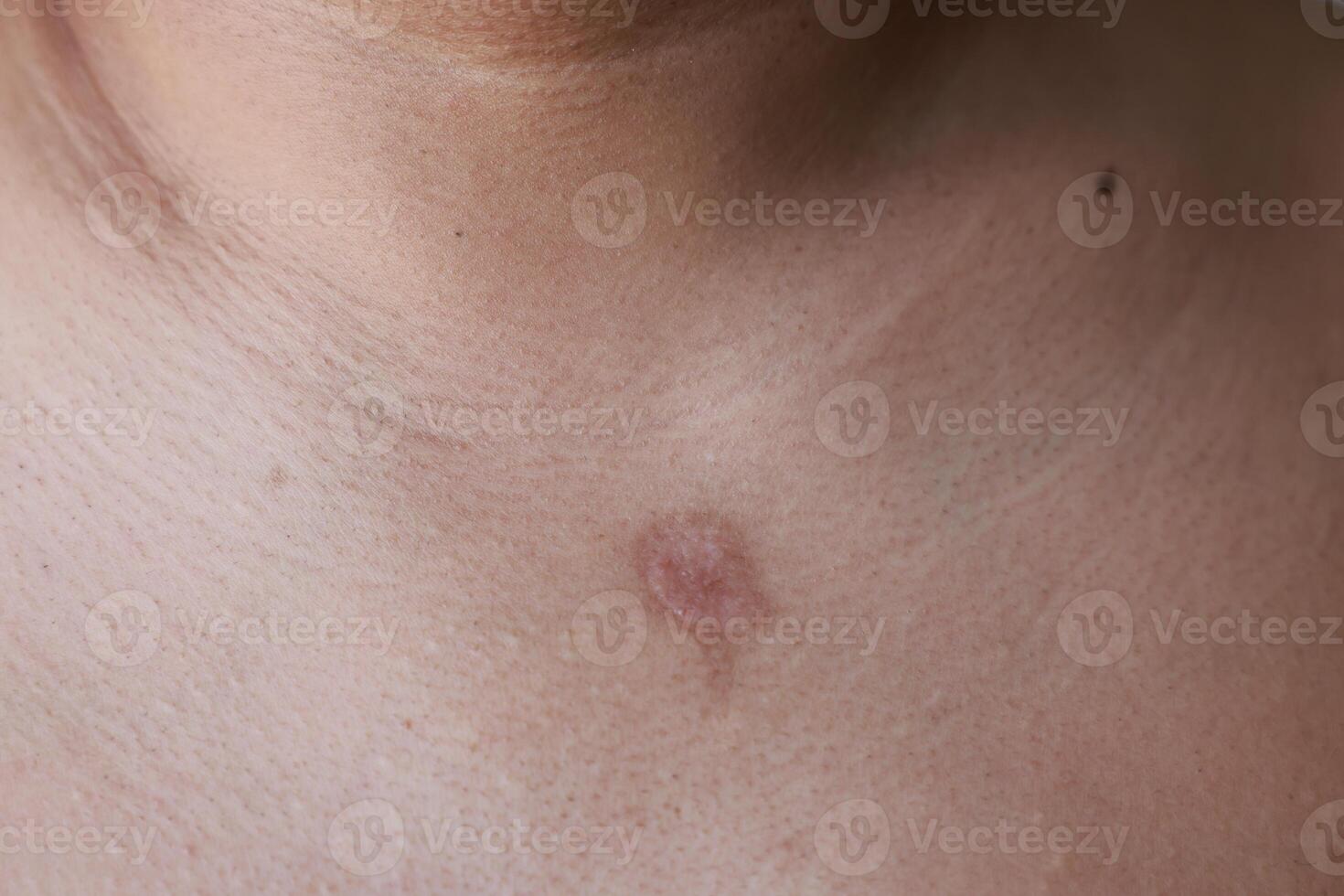 Asian man has blisters on his chest from oil splashes while cooking. Pityriasis rosea disease on the chest and neck on an isolated background. concept of healthcare, treat, medicine, injured. photo