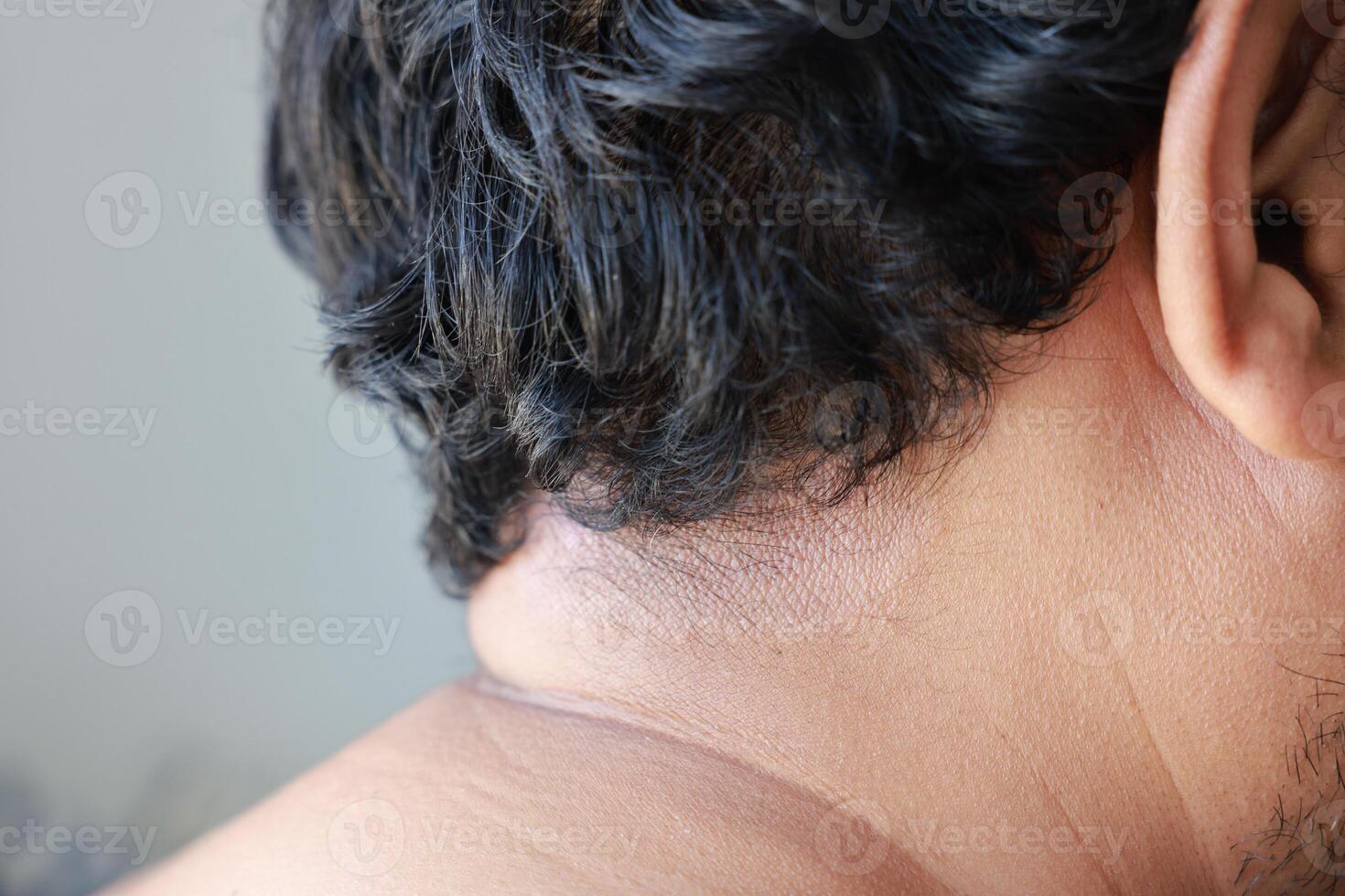 Asian men have a red, itchy, scaly rash skin rash caused by fungus. scalp dermatitis due to moisture-causing fungi. fungal itching. about of skin diseases-allergies, psoriasis, eczema, dermatitis. photo