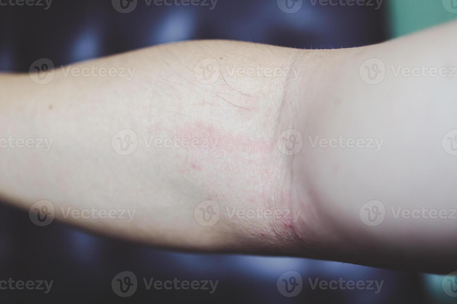Allergic rash dermatitis eczema skin of patient. hand in scratching itchy, itch red spot or rash of skin. Healthcare. photo