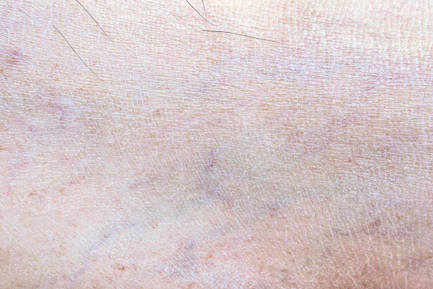 dry and dehydrated human skin texture background photo