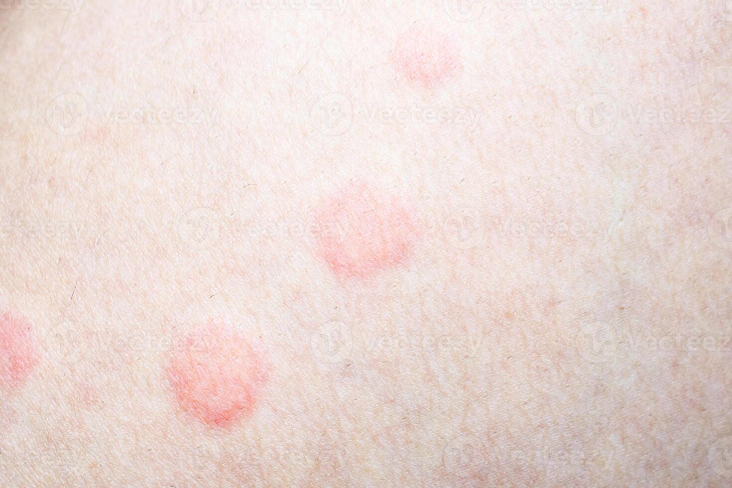 Skin allergy rash dermatitis texture close up photo