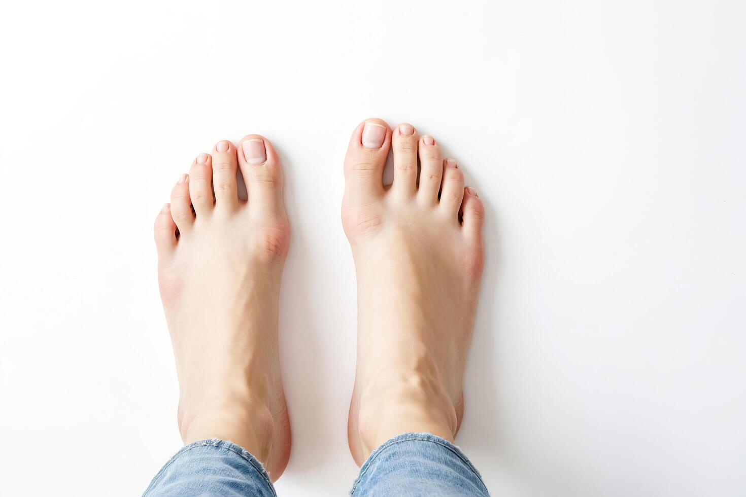Woman's feet with bunions photo