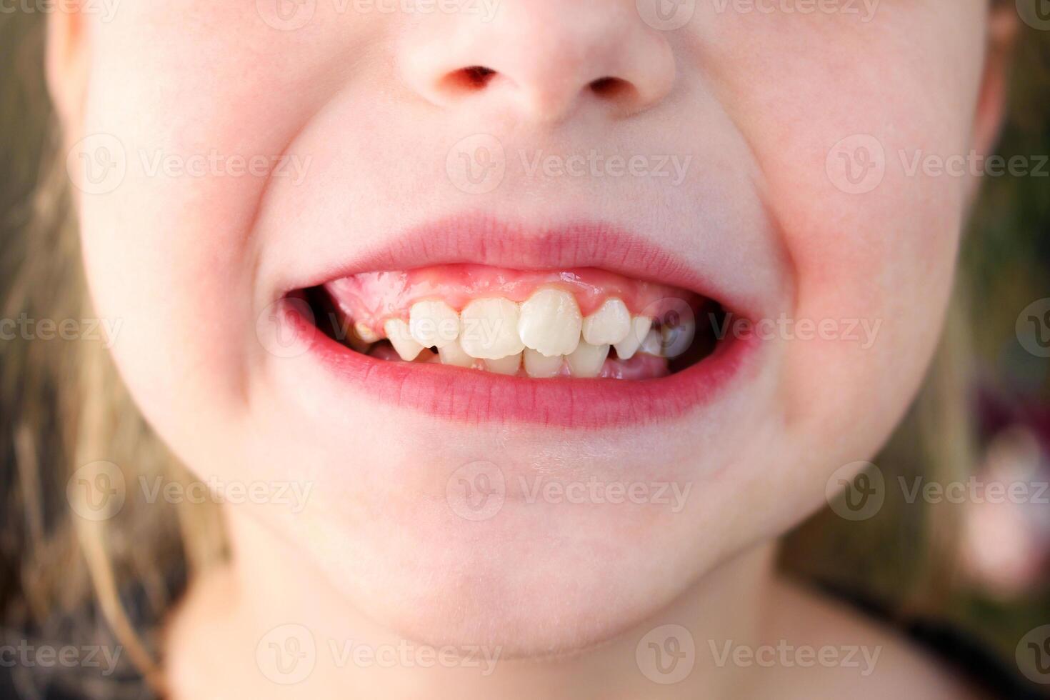 Child has crooked teeth. The concept of crowding of molars. photo