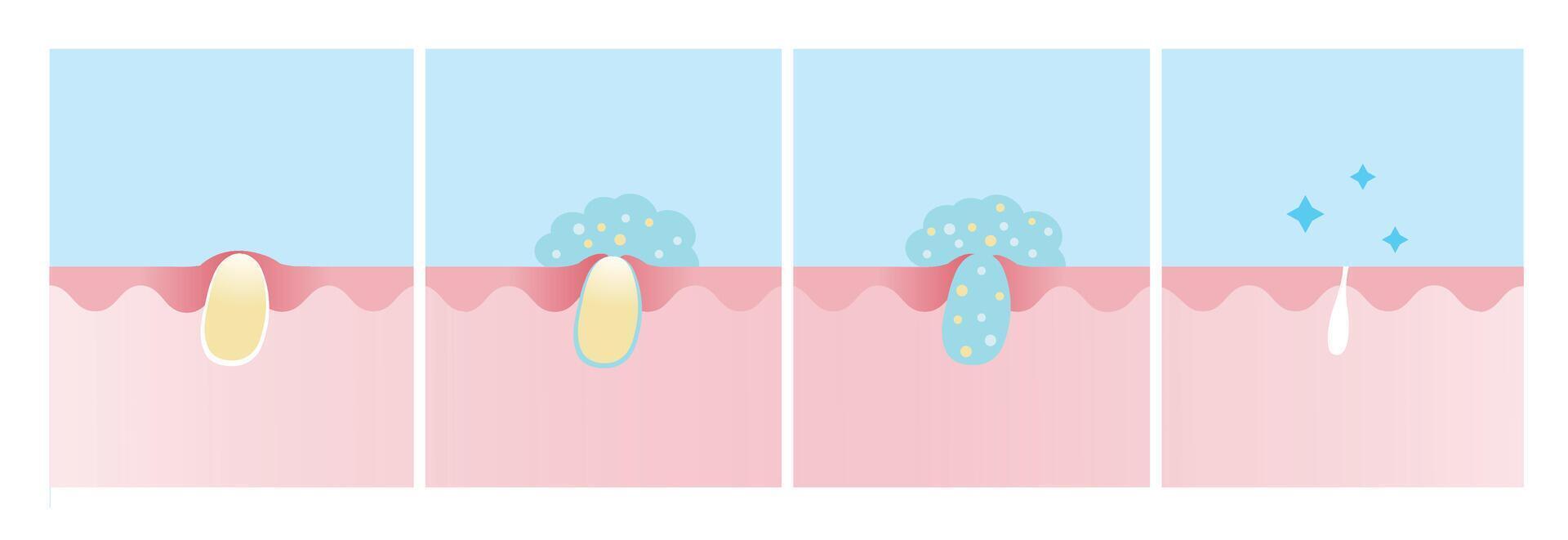 Step of acne pimple treatment process illustration. Apply salicylic acid on whitehead, penetrate into skin to dissolve closed plugged pore the dead skin cell, excess oil and keeping pore clear. vector
