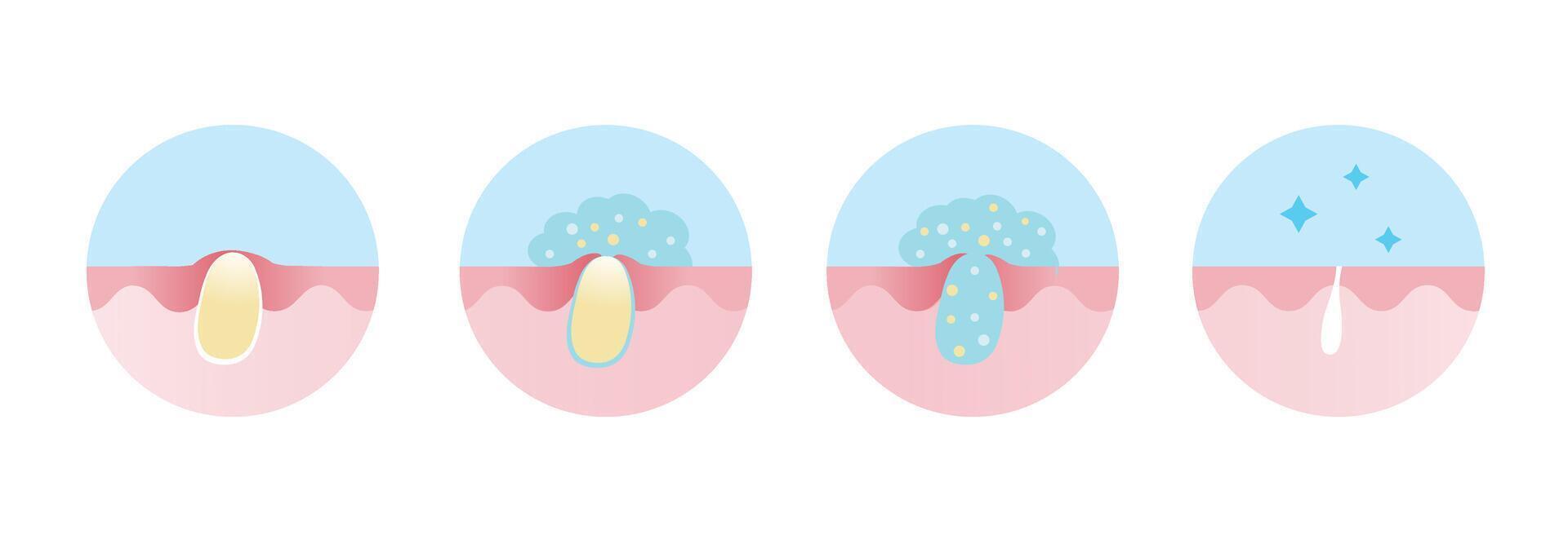 Process of acne pimple treatment icon set illustration. Apply salicylic acid on whitehead, penetrate into skin to dissolve closed plugged pore the dead skin cell, sebum and keeping pore clear. vector