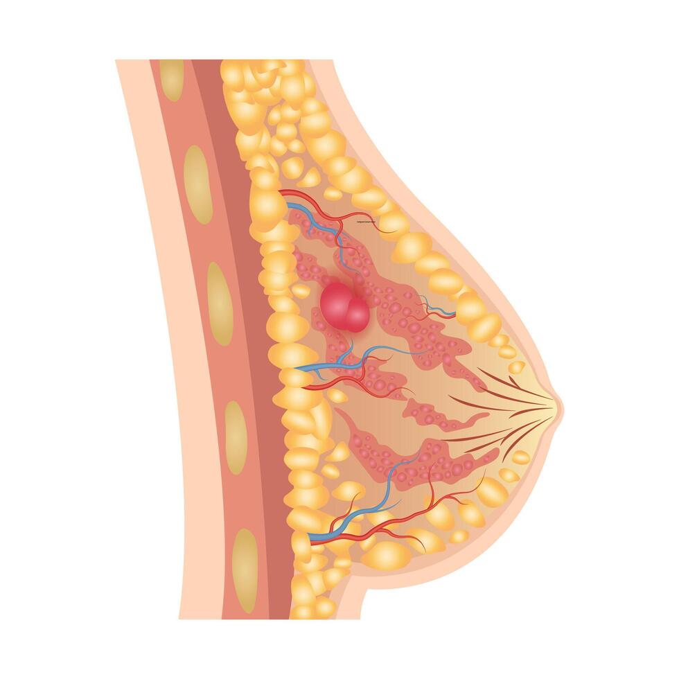 Breast cancer medical diagram with a cross-section vector
