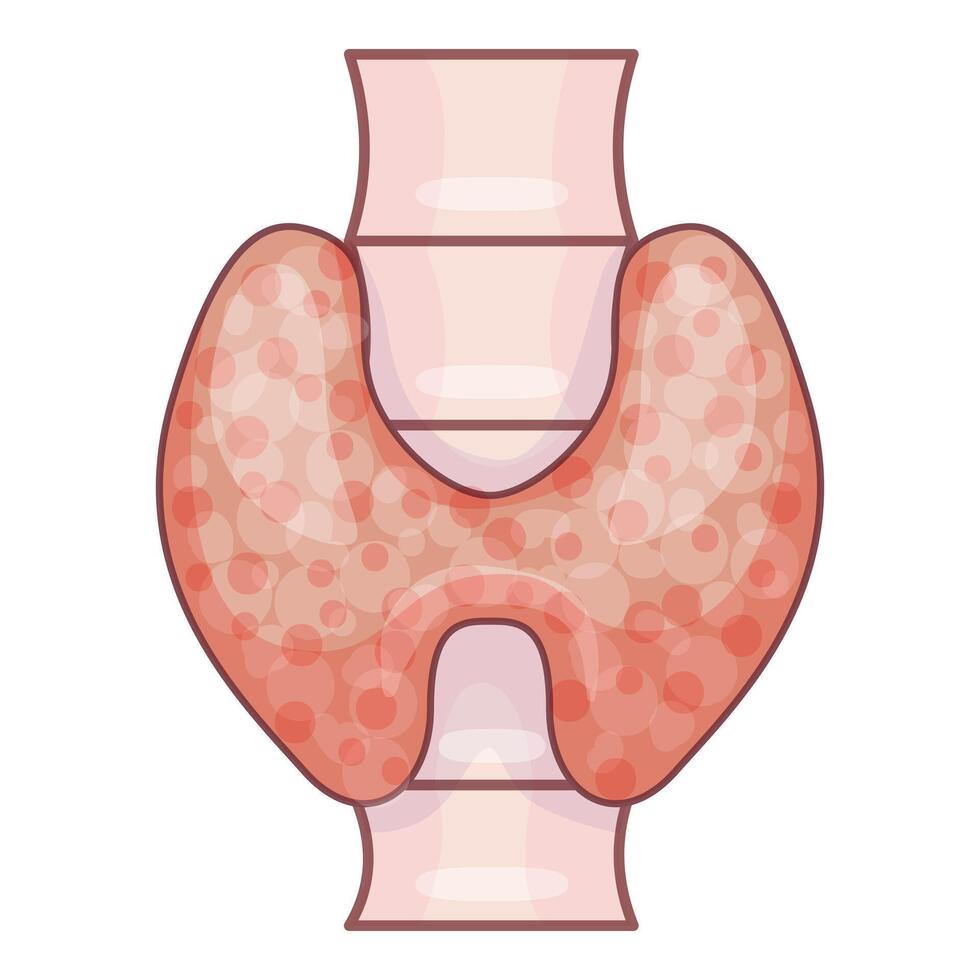 Human thyroid gland suffering from autoimmune disease illustration vector