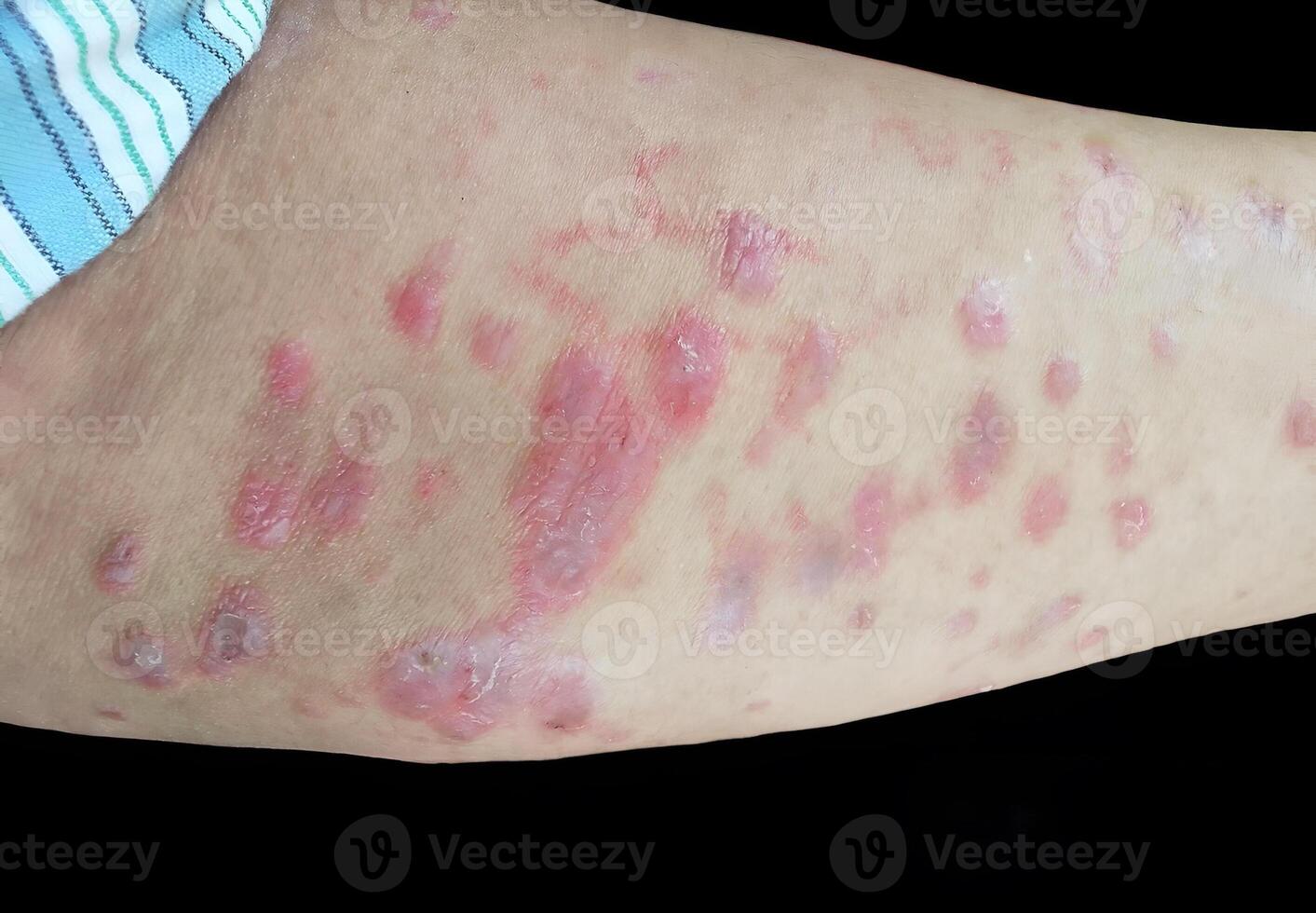 A raised, red, target like rash on the skin or mucous membranes characteristic of erythema multiforme photo