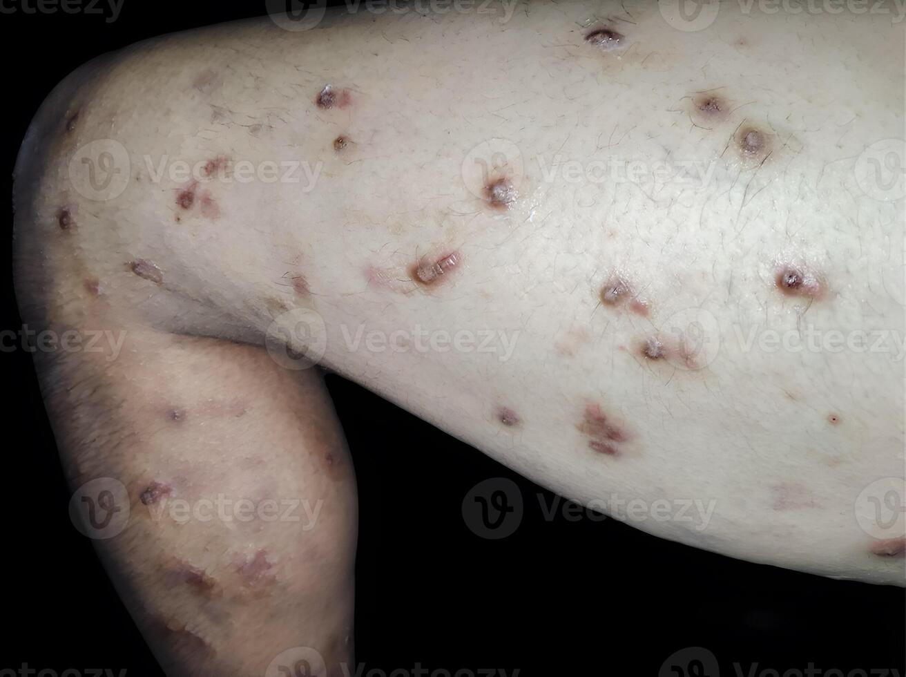 Multiple scattered lesions of varying sizes, some raised and reddish photo