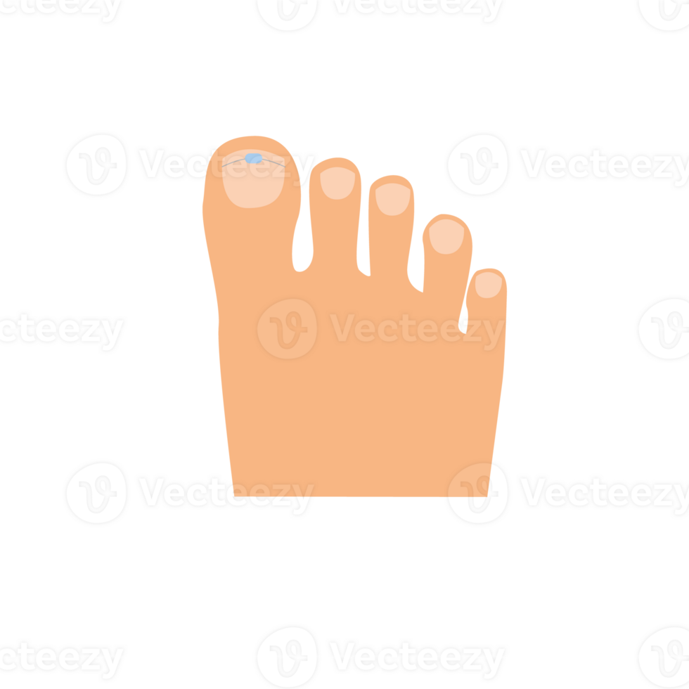 Toes on the right foot with a titanium staple on the thumb for correction of the shape of the toenail cartoon illustration isolated png