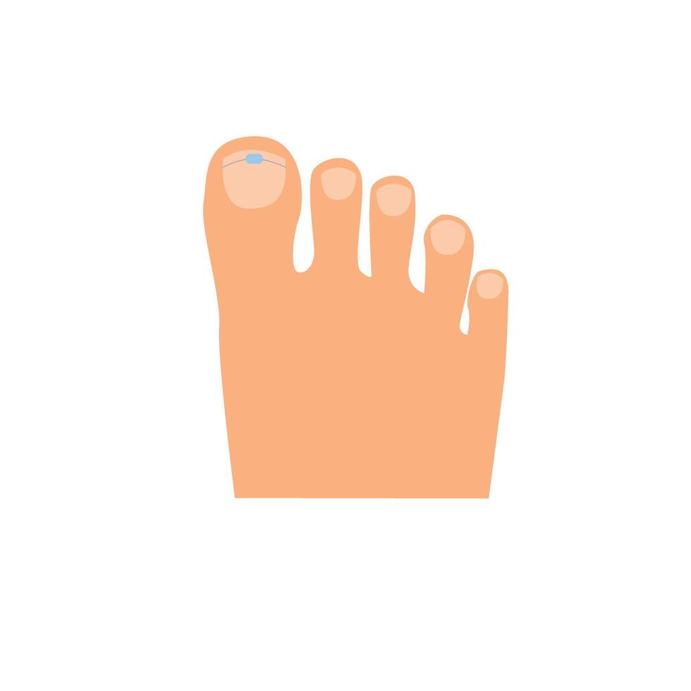 Toes on the right foot with a titanium staple on the thumb for correction of the shape of the toenail cartoon vector
