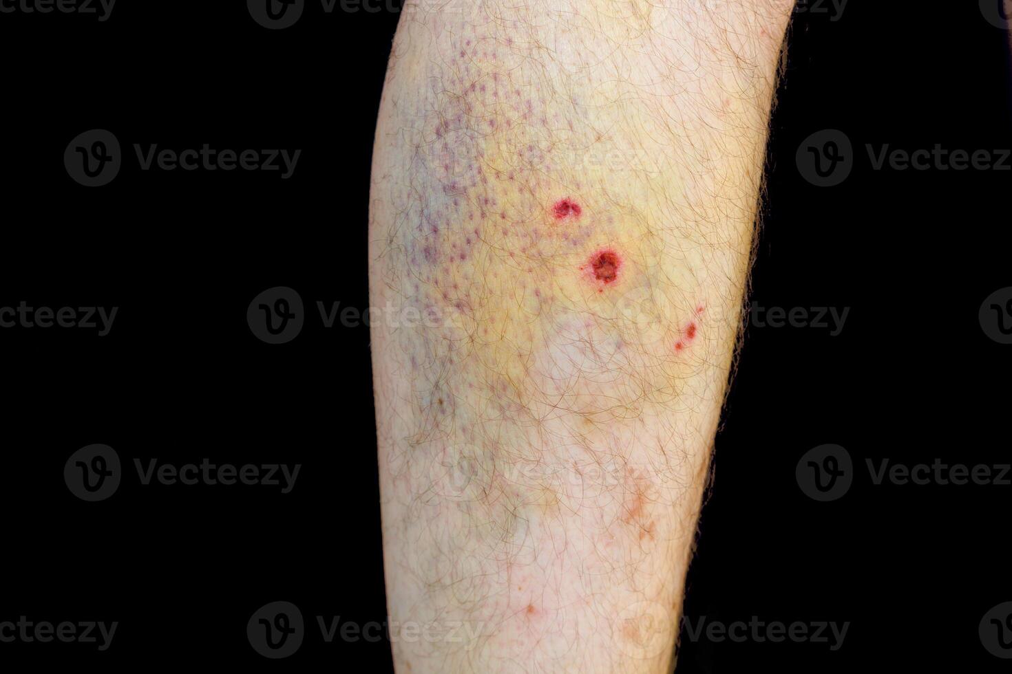 Injured shin, injuries and bruises after a fall photo