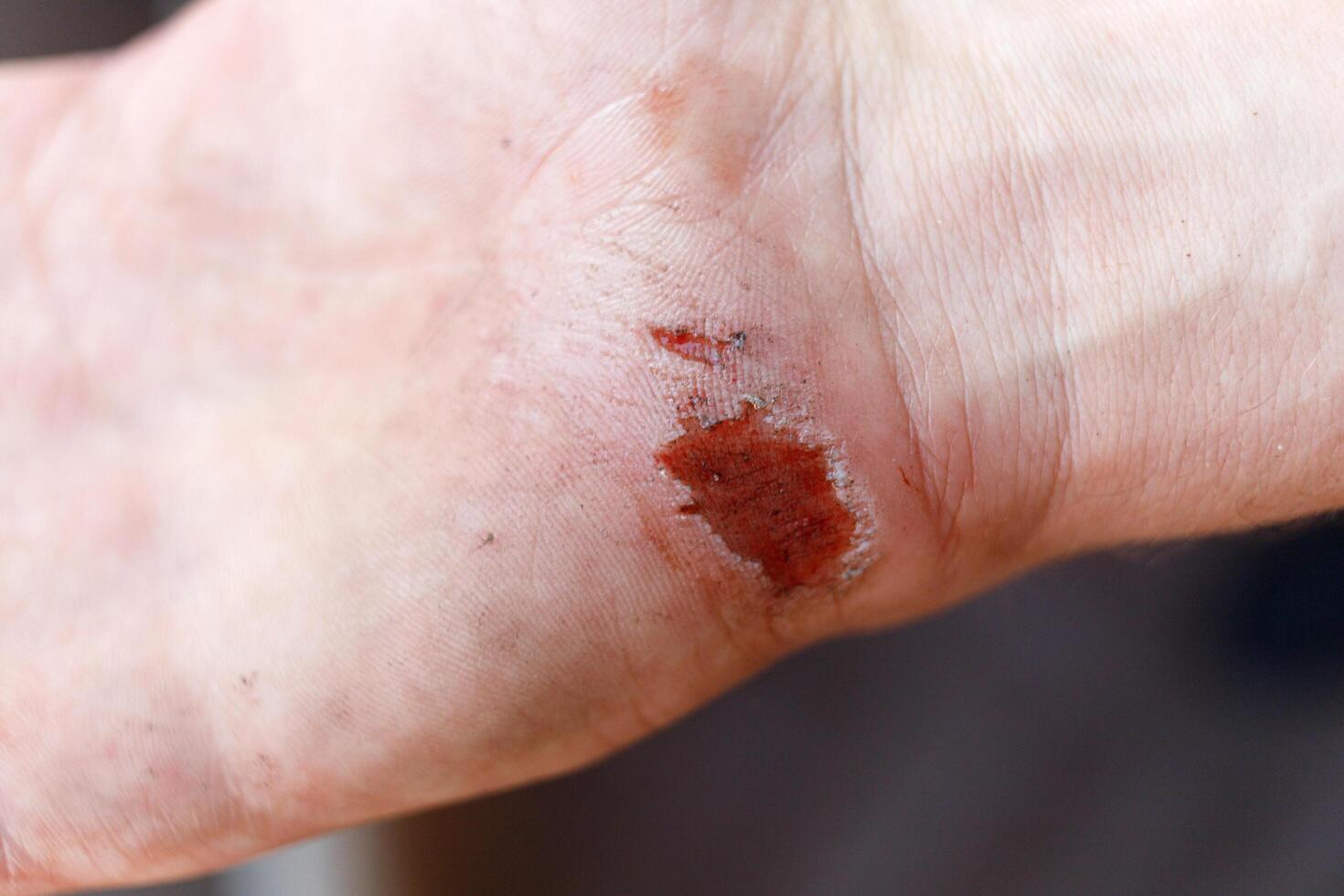 Wound on the palm after a fall. Abraded skin on the hand. photo