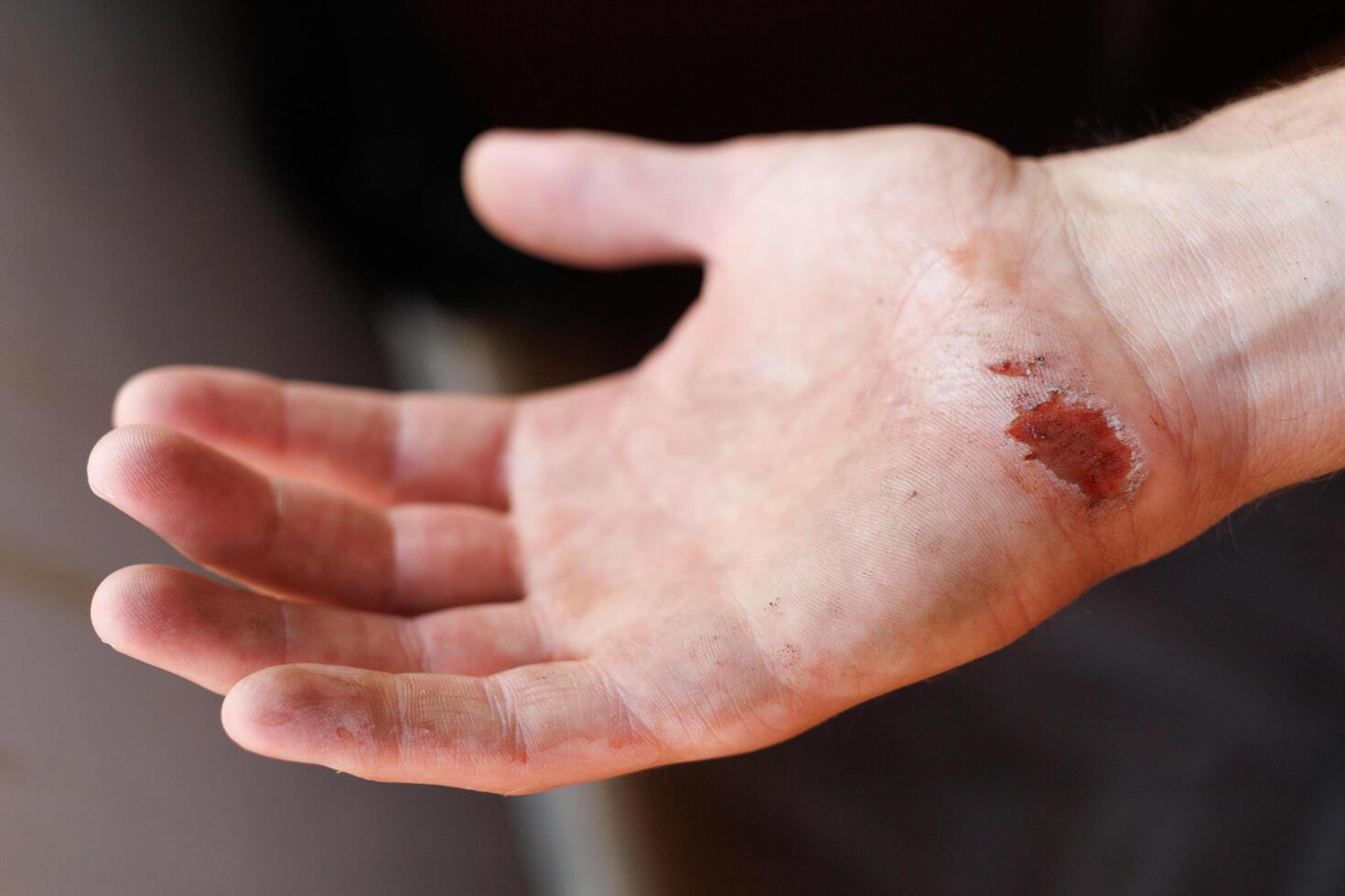 Wound on the palm after a fall. Abraded skin on the hand. photo