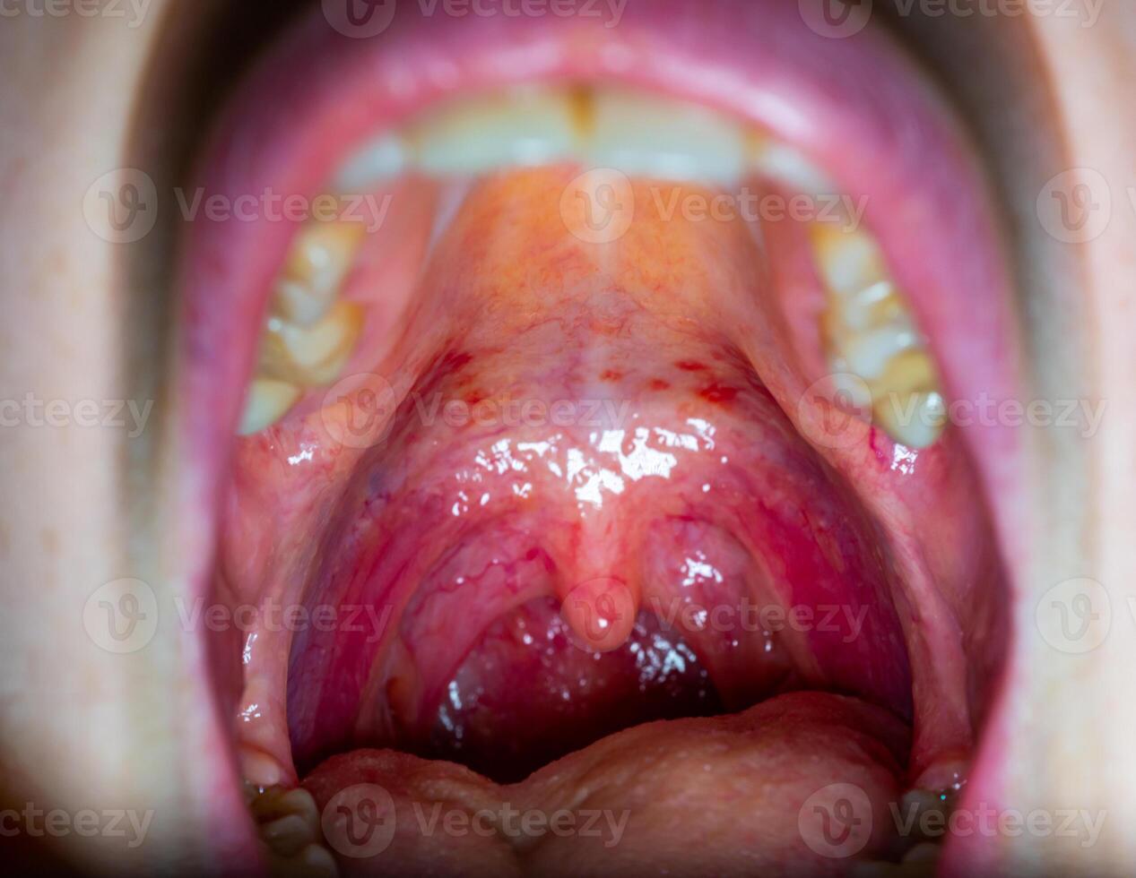 Inflamed throat of a sick person, red blood vessels of the upper wall of the oral cavity photo
