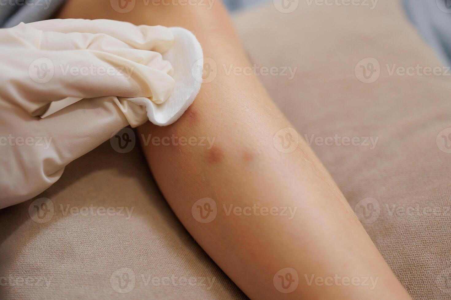 a small skin infection caused by mosquito bites that causes itching and redness. A mother applies cream to a child on the site of a mosquito bite. photo