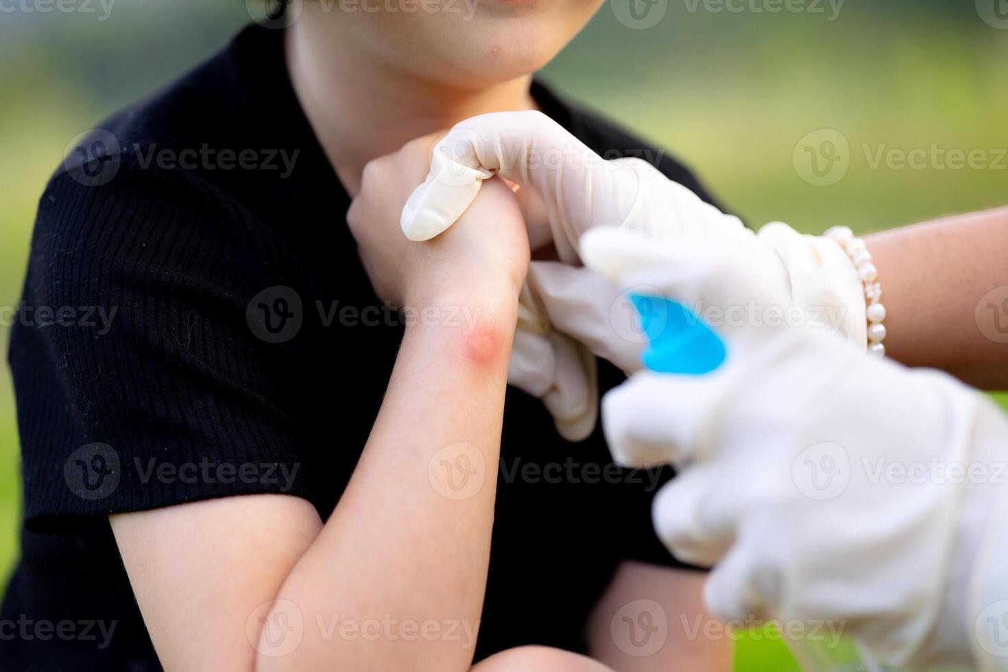 close-up photo of a mother applying spray to her child's hand after an insect, mosquito or bee bite in the summer in the yard