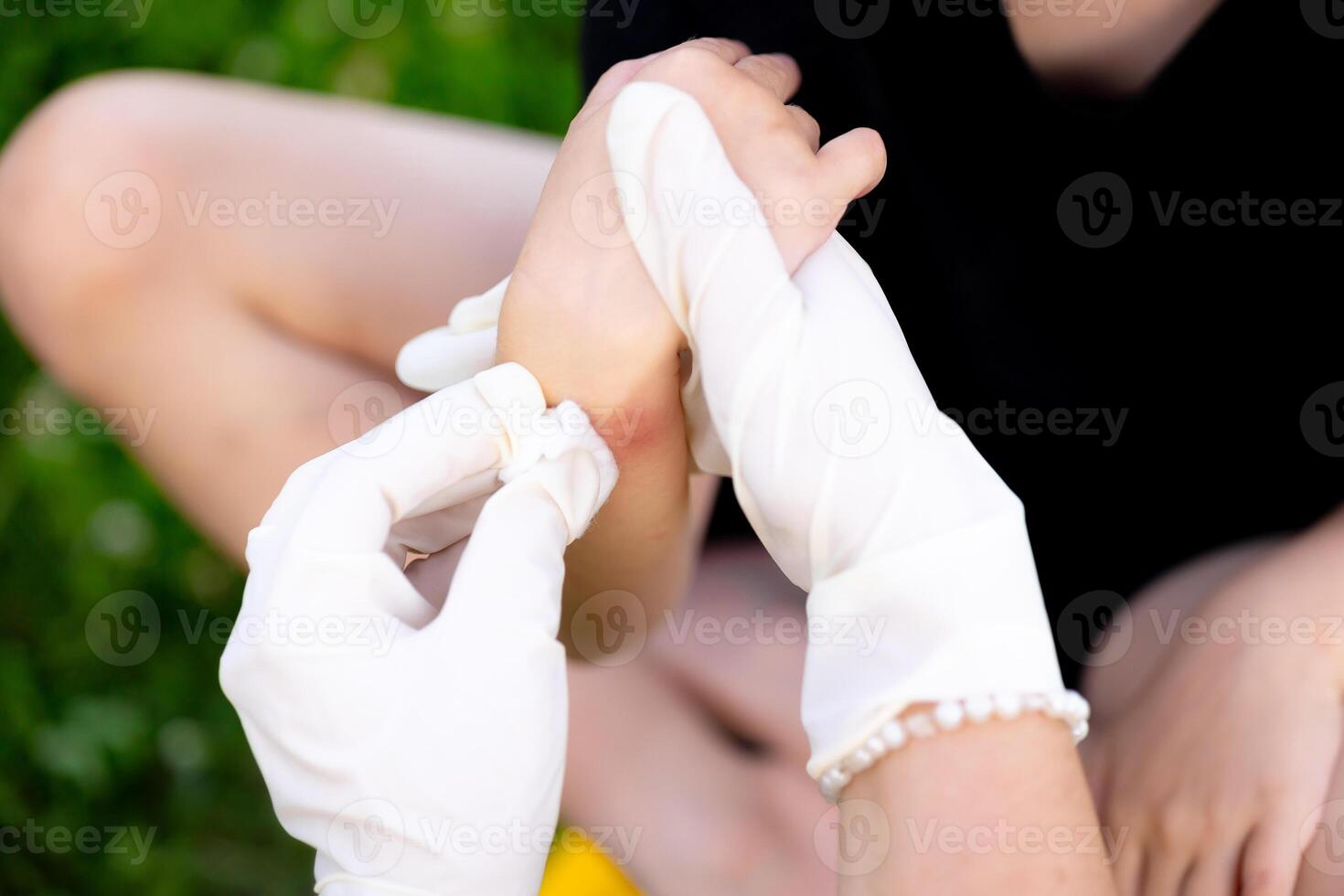 close-up photo of a mother applying cream to her child's hand after an insect, mosquito or bee bite in the summer in the yard