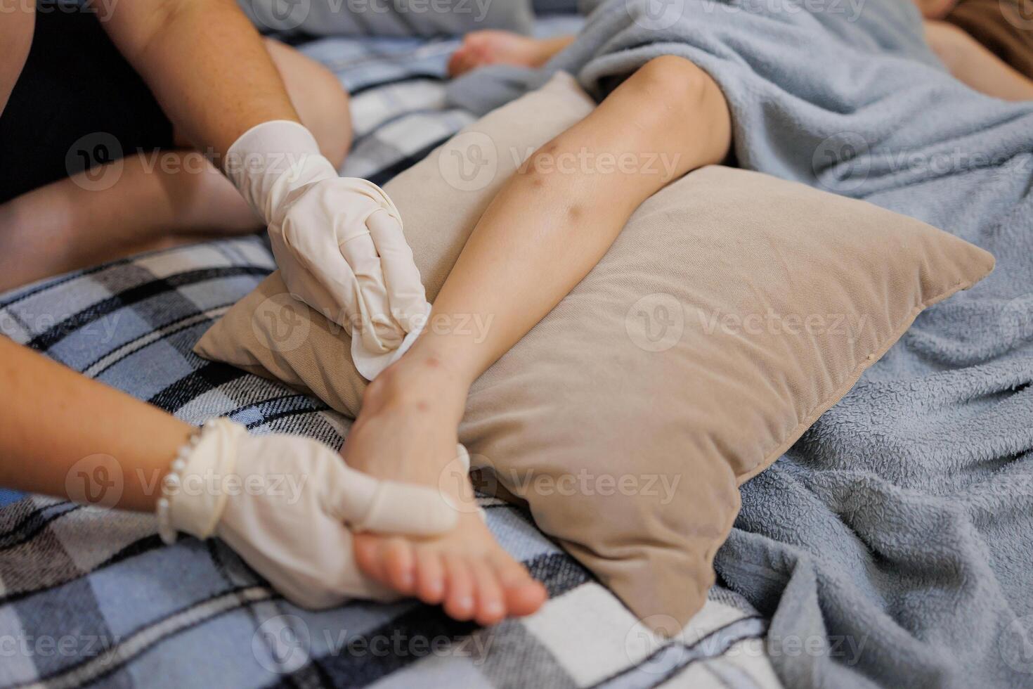 a small skin infection caused by mosquito bites that causes itching and redness. A mother applies cream to a child on the site of a mosquito bite. photo