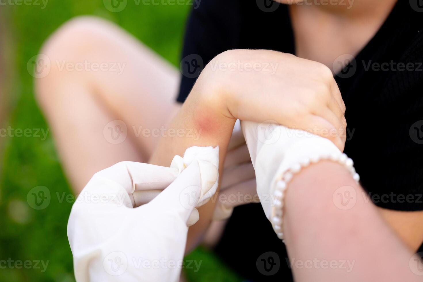 close-up photo of a mother applying cream to her child's hand after an insect, mosquito or bee bite in the summer in the yard
