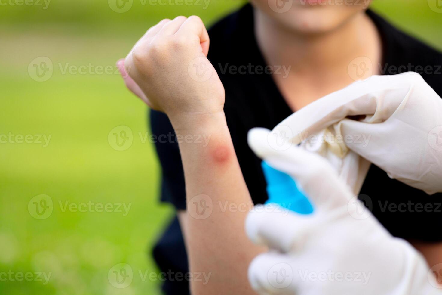 close-up photo of a mother applying spray to her child's hand after an insect, mosquito or bee bite in the summer in the yard