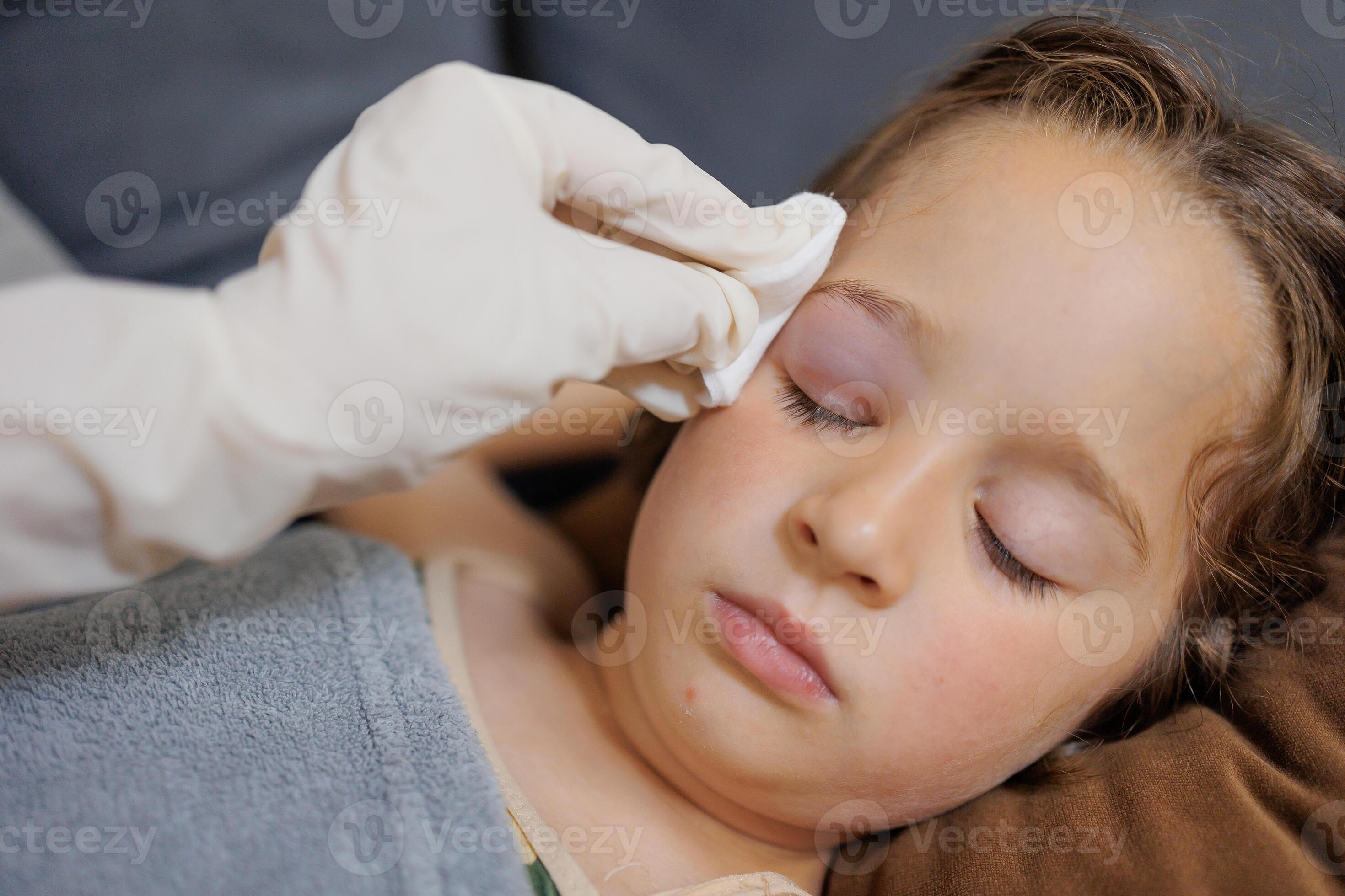 a small childhood infection on the eyelid caused by insect, mosquito or bee bites that causes