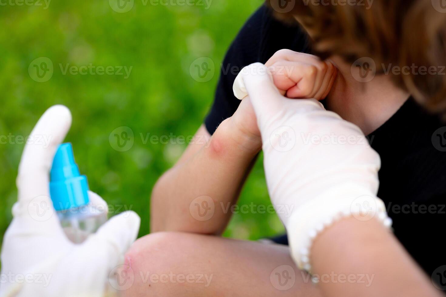 close-up photo of a mother applying spray to her child's hand after an insect, mosquito or bee bite in the summer in the yard