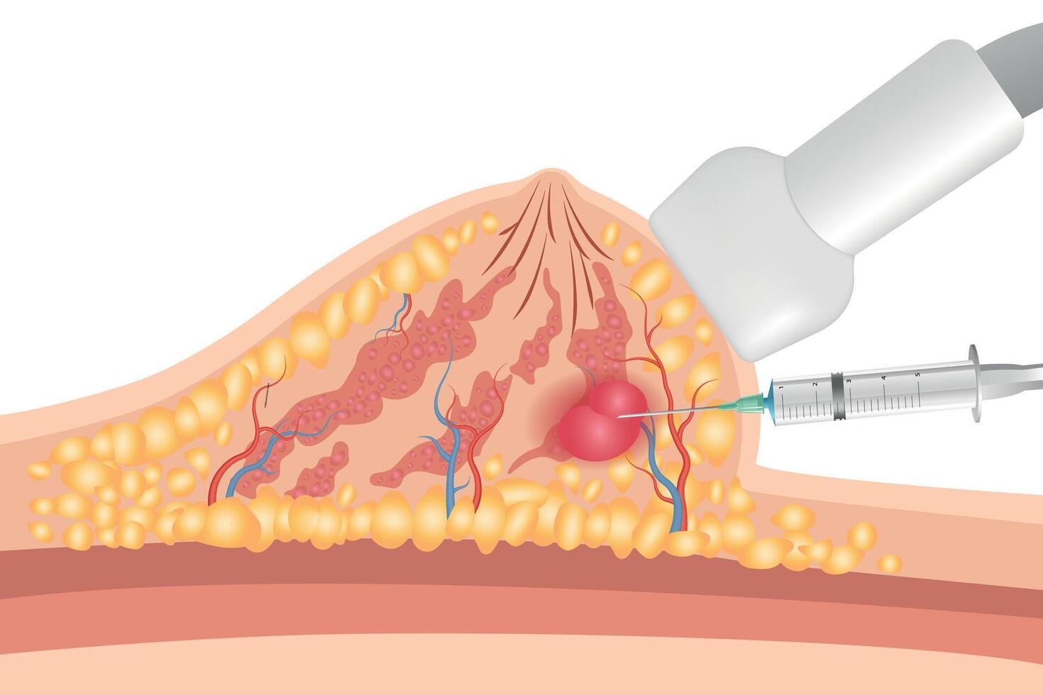diagram with a cross-section of female breast anatomical structure and illustration of malignant breast tumor affected by cancer vector