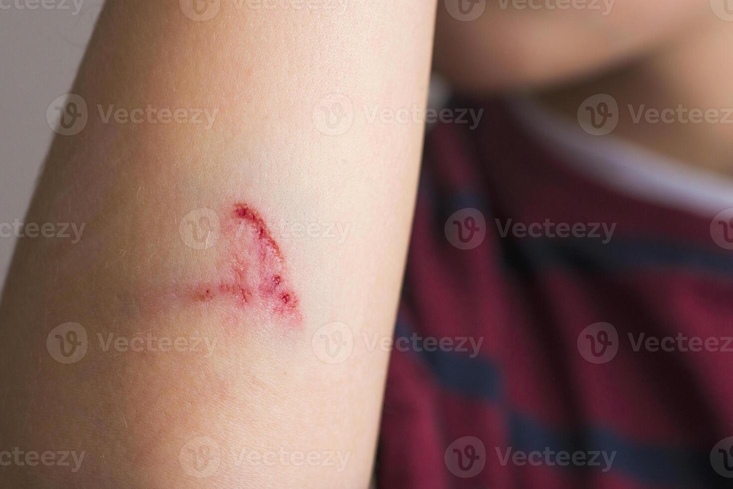 Close-Up of a Child's Arm with a Scratch. photo