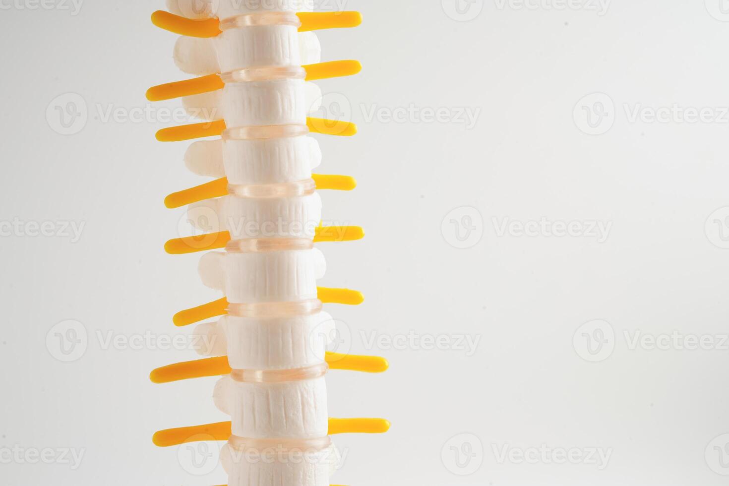 Spinal nerve and bone, Lumbar spine displaced herniated disc fragment, Model for treatment medical in the orthopedic department. photo