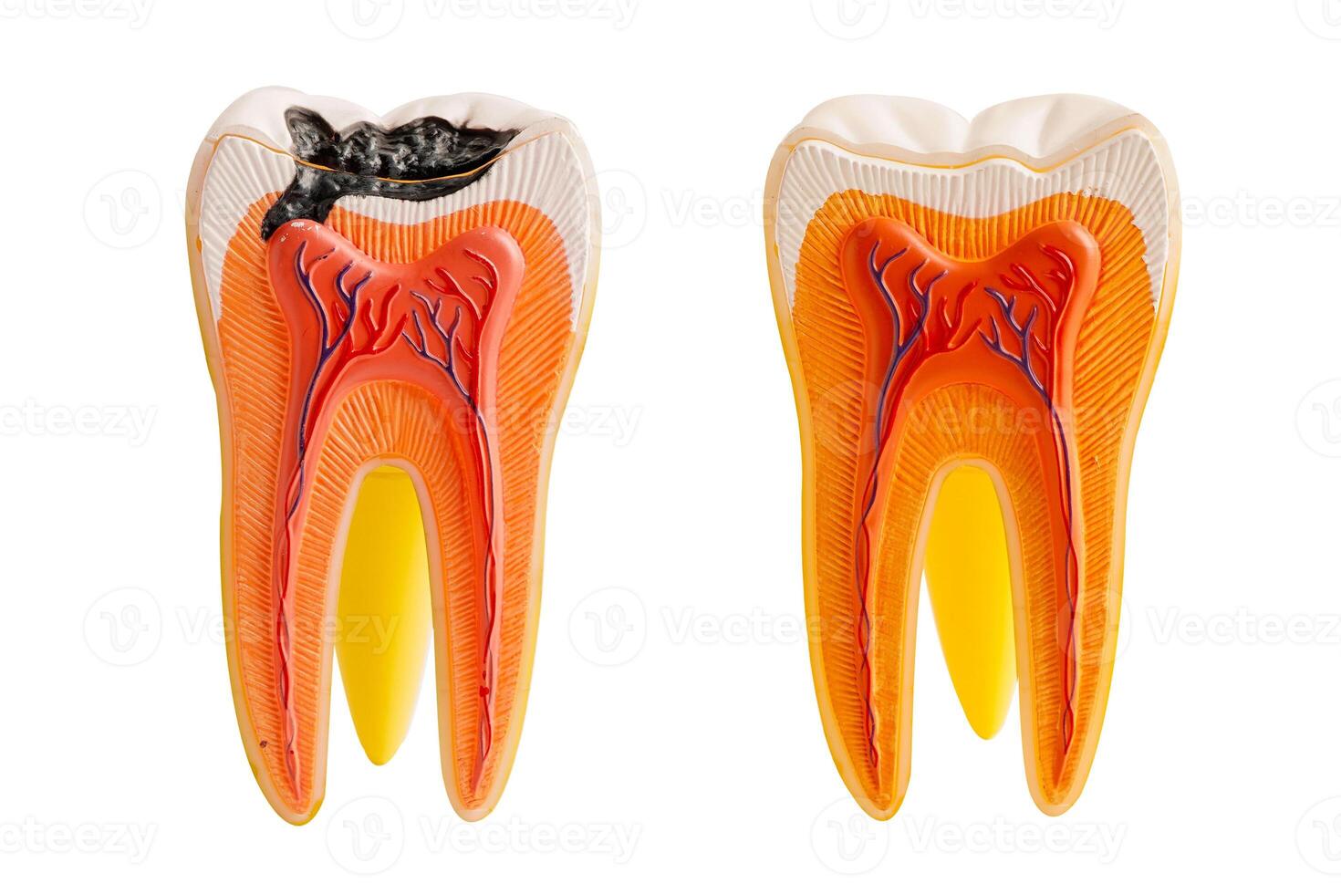Decay tooth replace with dental implant root canal teeth model for education isolated on white background. photo