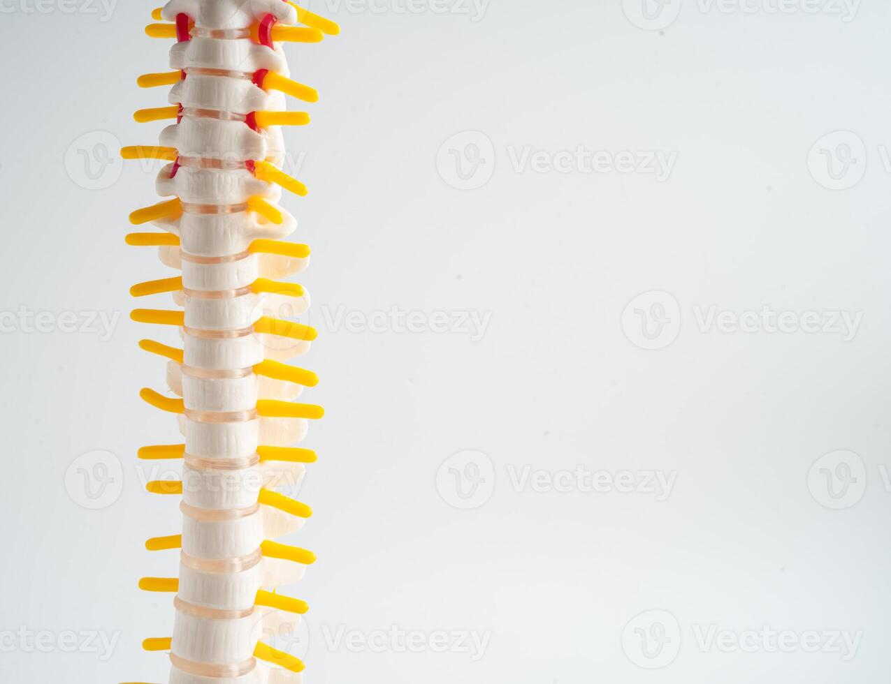 Lumbar spine displaced herniated disc fragment, spinal nerve and bone. Model for treatment medical in the orthopedic department. photo