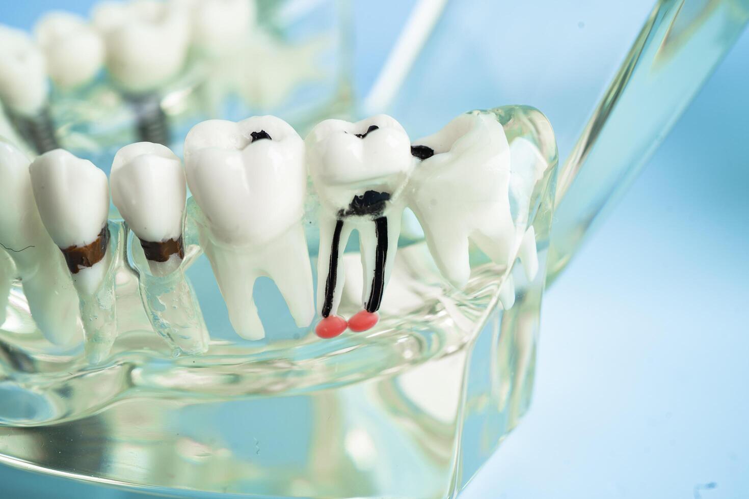 Dental implant, artificial tooth roots into jaw, root canal of dental treatment, gum disease, teeth model for dentist studying about dentistry. photo