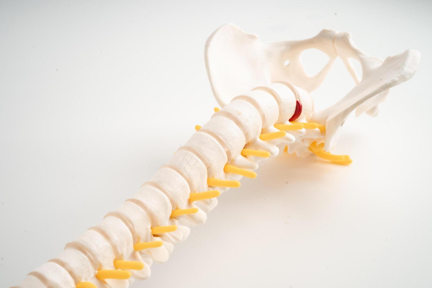 Lumbar spine displaced herniated disc fragment, spinal nerve and bone. Model for treatment medical in the orthopedic department. photo