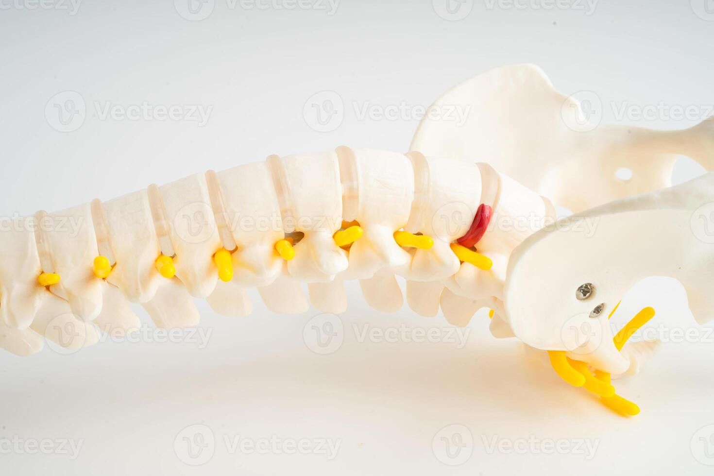 Lumbar spine displaced herniated disc fragment, spinal nerve and bone. Model for treatment medical in the orthopedic department. photo