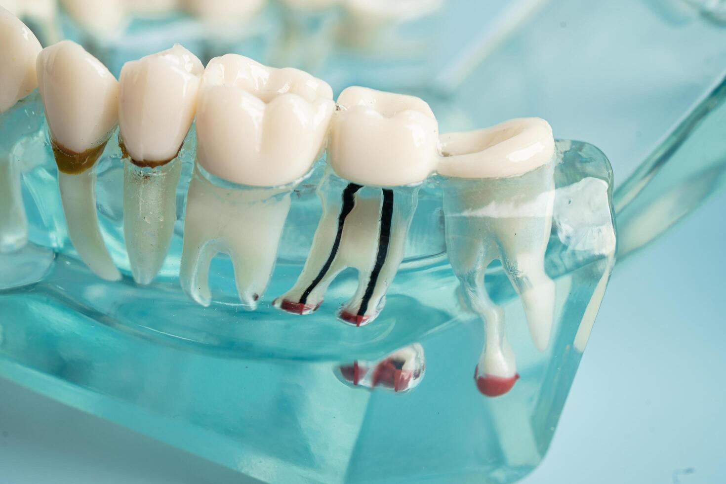 Dental implant, artificial tooth roots into jaw, root canal of dental treatment, gum disease, teeth model for dentist studying about dentistry. photo