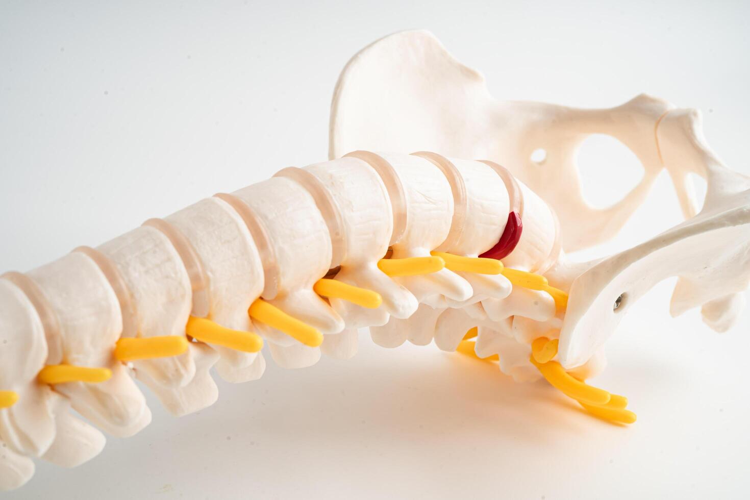 Lumbar spine displaced herniated disc fragment, spinal nerve and bone. Model for treatment medical in the orthopedic department. photo