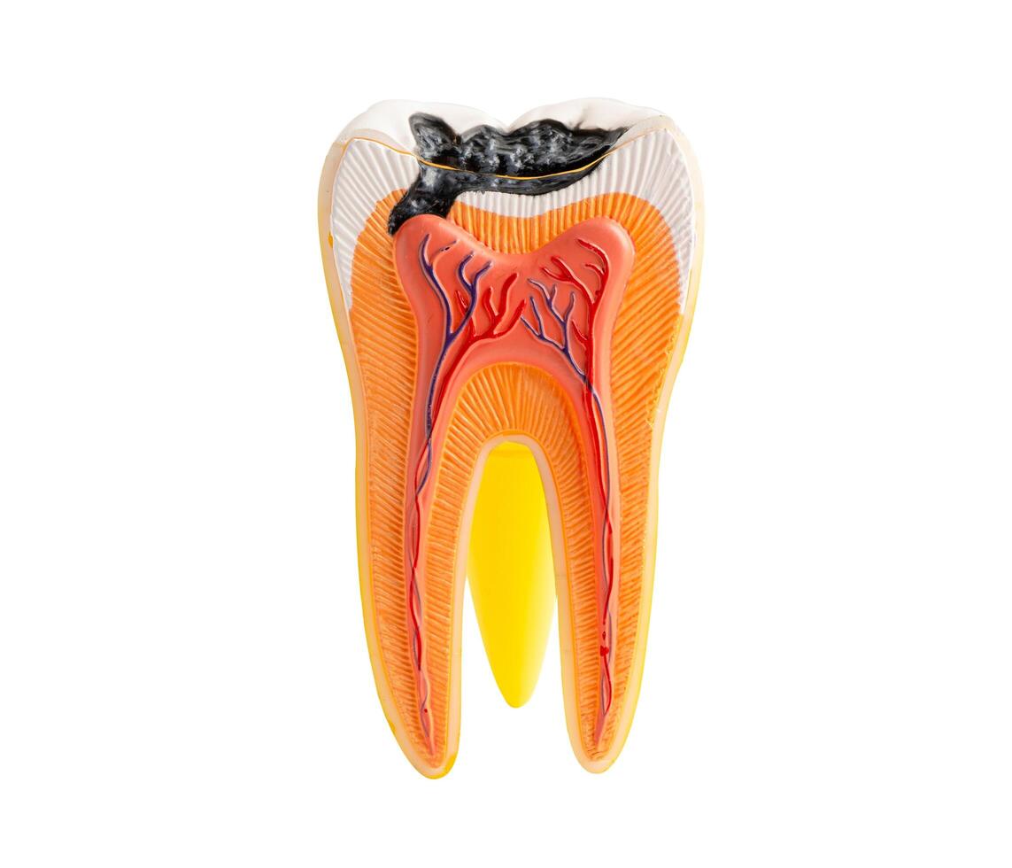 Tooth decay model isolated on white background with clipping path. photo