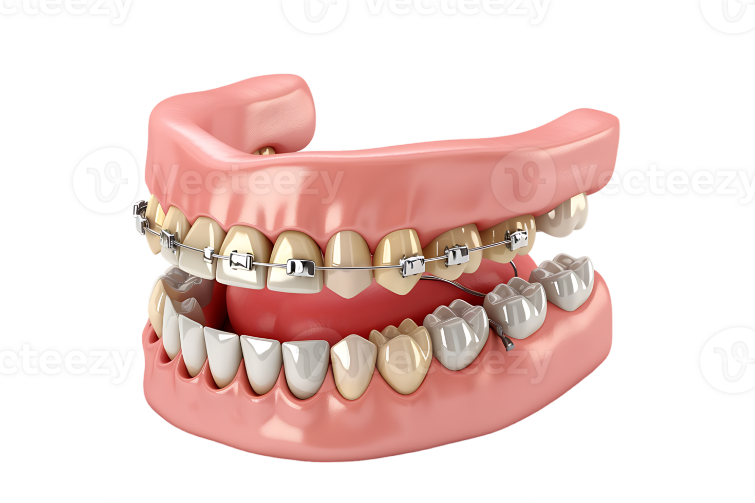 Dentures with braces, isolated against a transparent background png