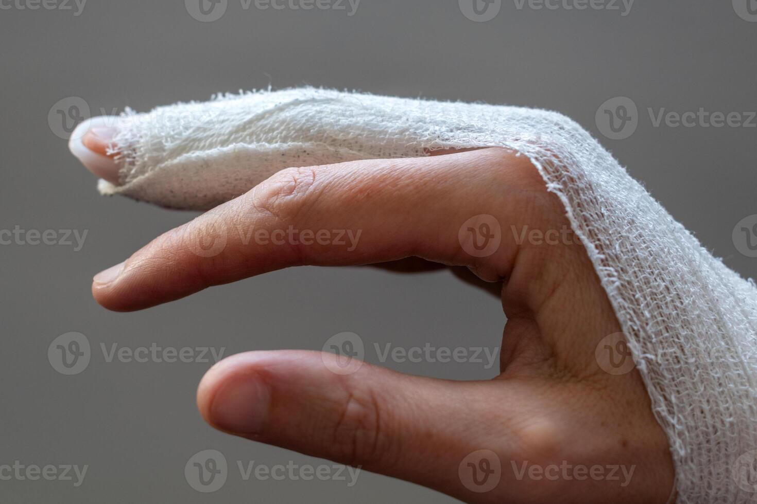 Mallet finger, stack splint on the middle finger with bandage to immobilize the last phalanx following joint trauma photo