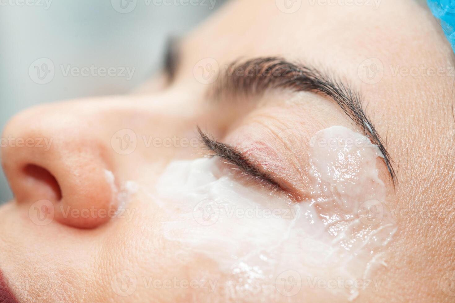 Application of topical anesthesia cream prior to a dermatological procedure. photo