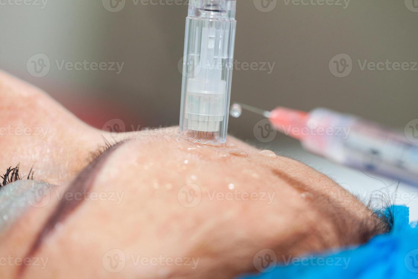 Application of an anti-aging facial rejuvenation cocktail using micro needles. Dermatology concept. Aesthetic medicine concept. photo