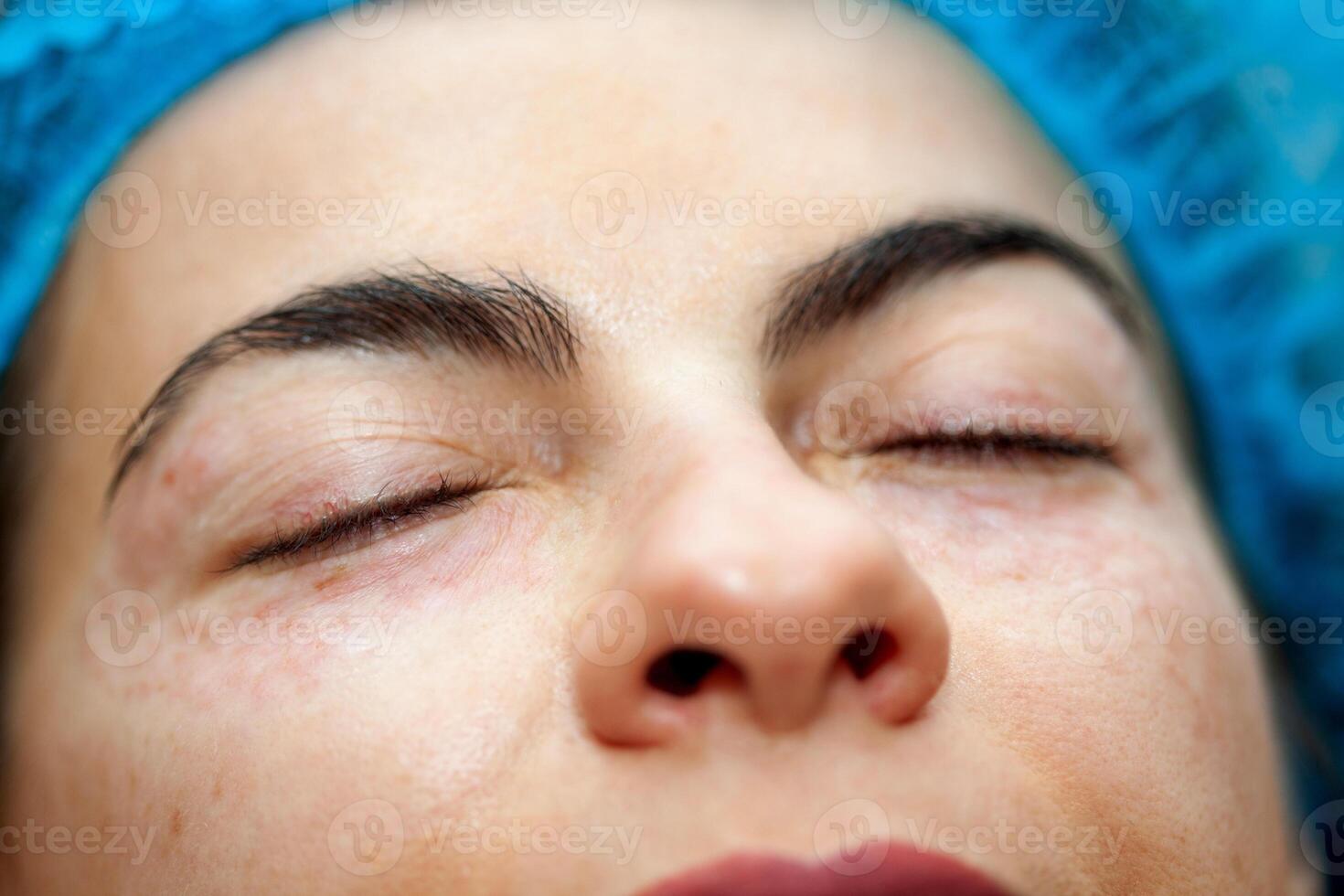 Female patient receiving a mesotherapy hydration procedure on eyelids with microneedles at dermatologist office. photo