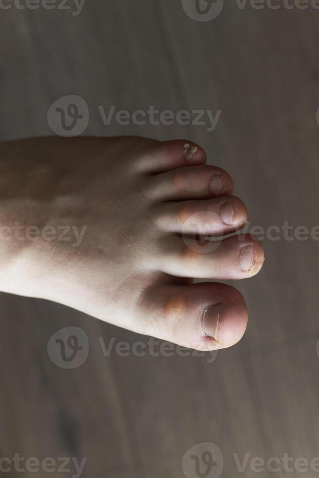 Foot with corns, calluses and dry skin photo