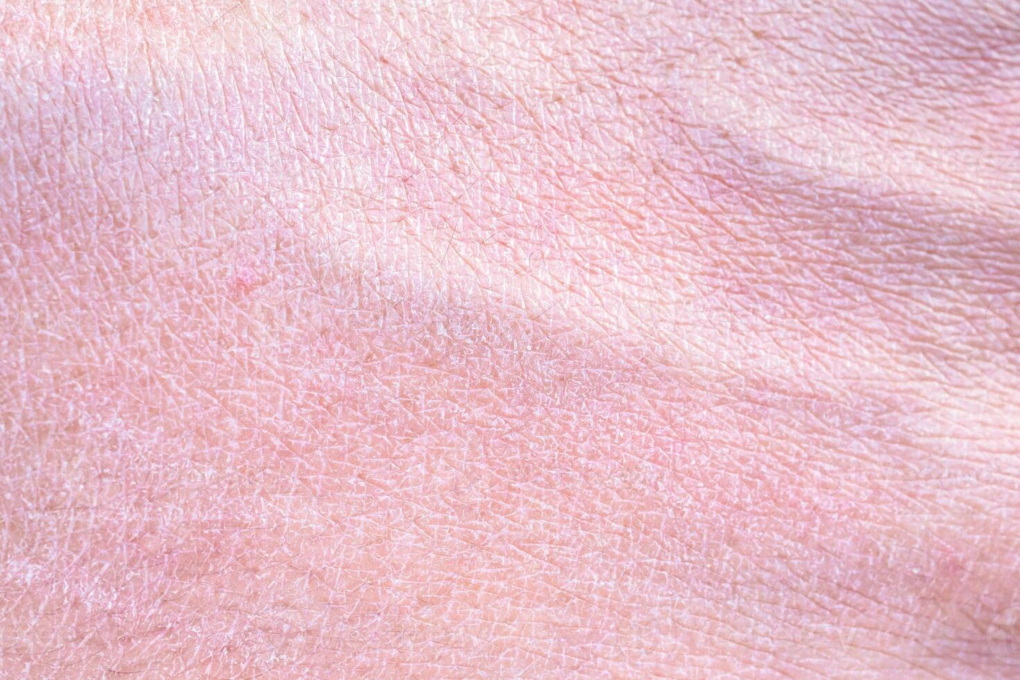 dry and dehydrated human skin texture background photo