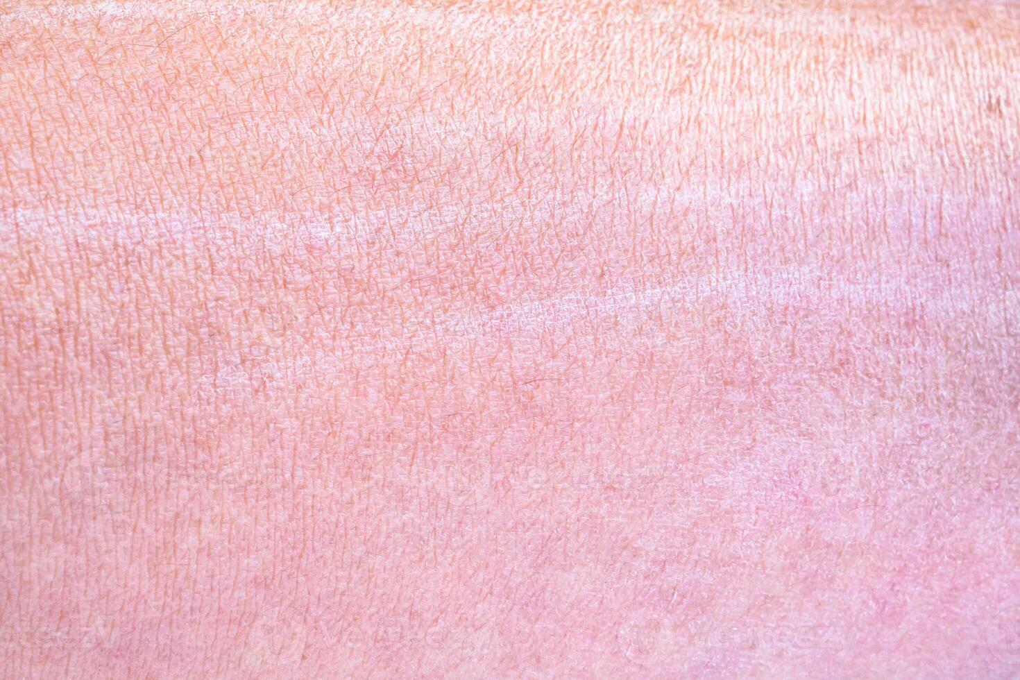 dry and dehydrated human skin texture background photo