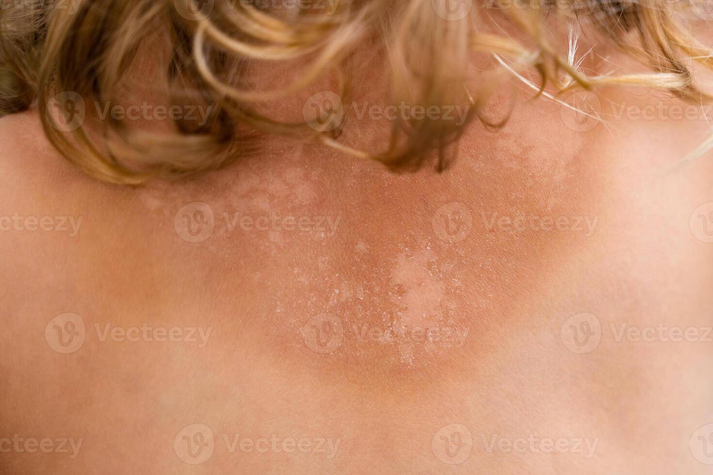 The skin is very peeling after sunbathing, the tanned back of a little girl. Sunburn concept. High quality photo