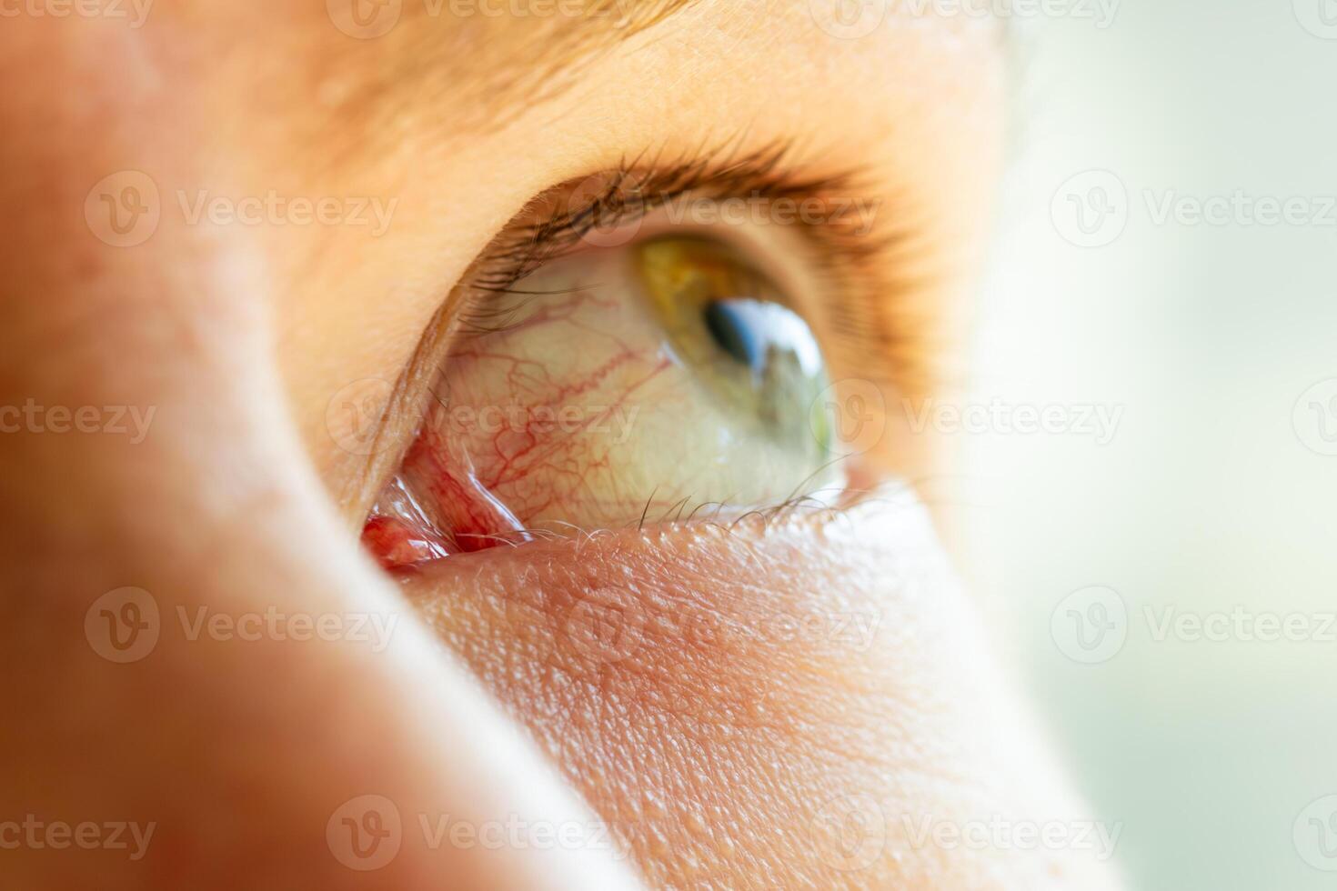 green human eye close-up with a beautiful reflection of the sky in the pupil, whites of the eye with red capillaries from fatigue , medicine vision concept photo